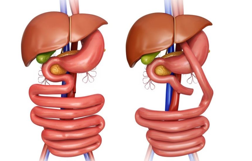 Some Bariatric Surgery Options